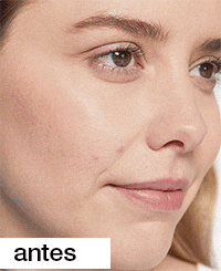 Game Changer: How to Heal and Conceal Acne | The Wink on Clinique